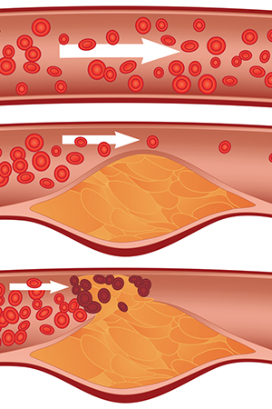Cholesterol
